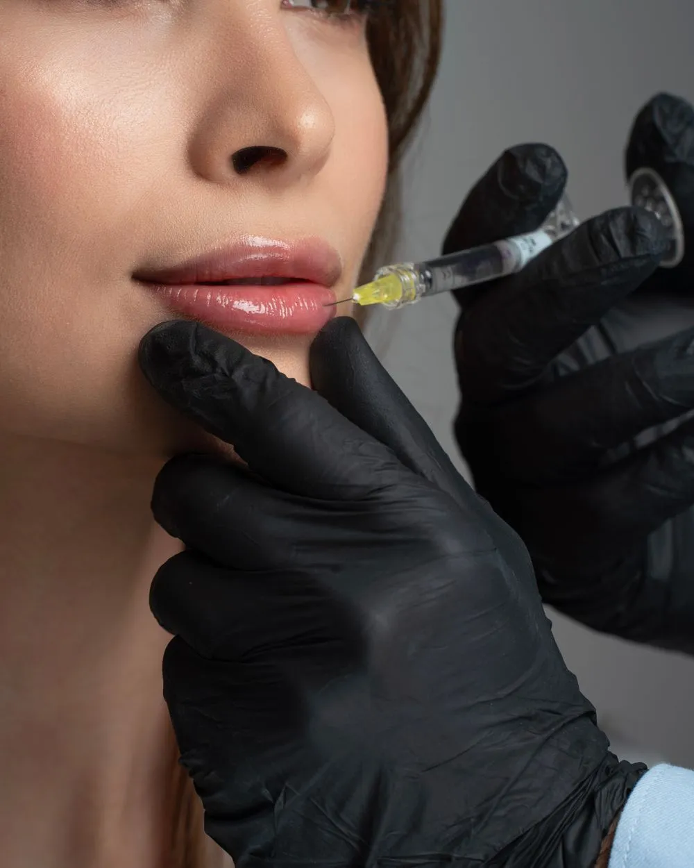 Injection d'acide hyaluronique aux lèvres, réalisée avec des gants noirs